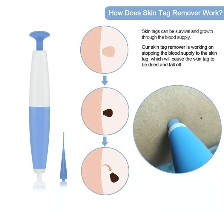 Painless Skin Tag Removal Kit for Safe At Home Skin Care Treatment