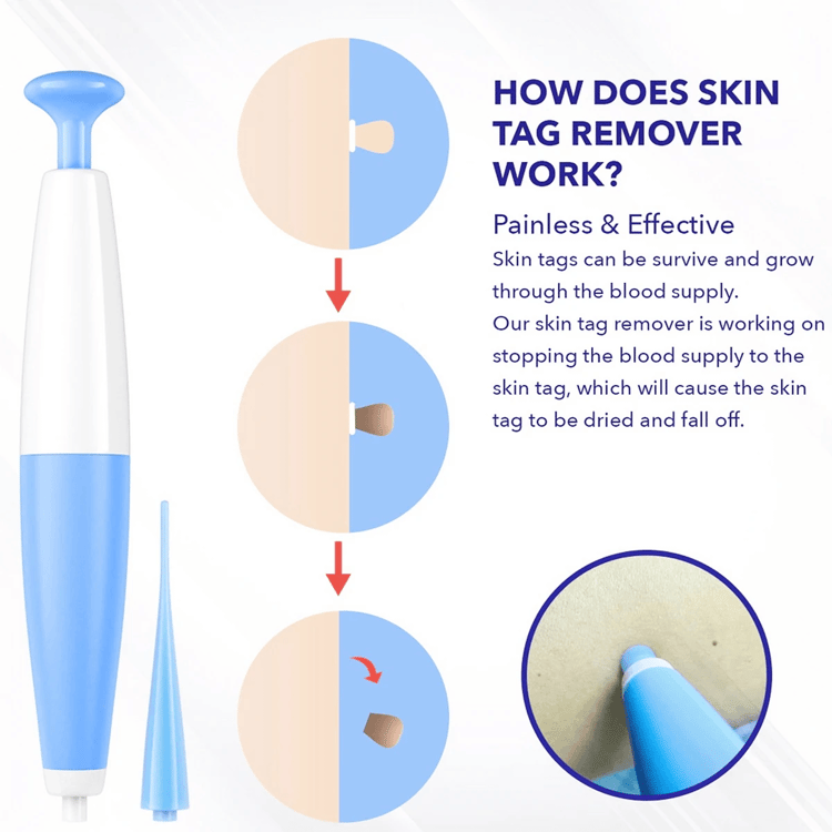 Painless Skin Tag Removal Kit for Safe At Home Skin Care Treatment